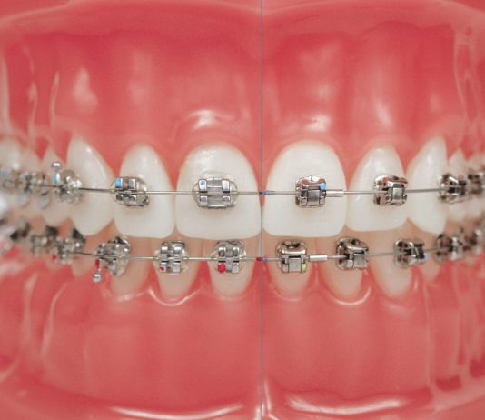 Какие бывают виды брекетов и в пользу каких сделать выбор?