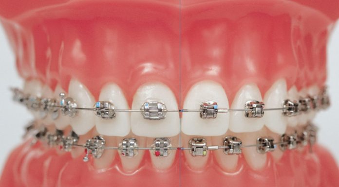 Какие бывают виды брекетов и в пользу каких сделать выбор?