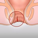 Как лечить трещину прямой кишки