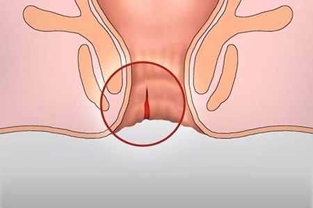 Как лечить трещину прямой кишки