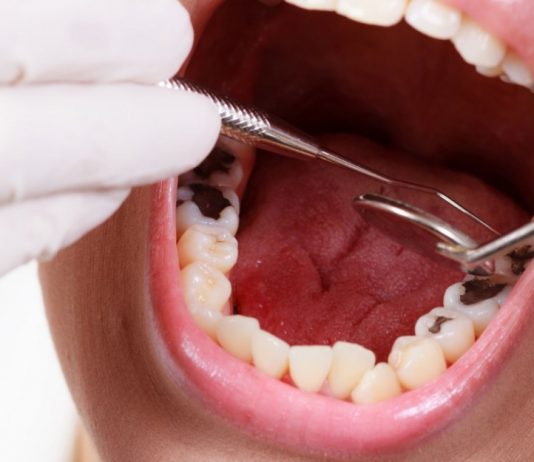 Как убирают кариес на зубах?