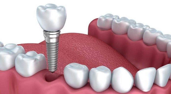 Что такое дентальная имплантация и каковы ее преимущества