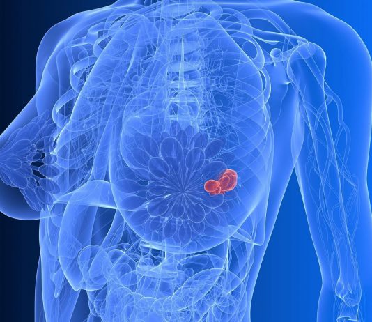 Можно ли излечиться от рака молочной железы?