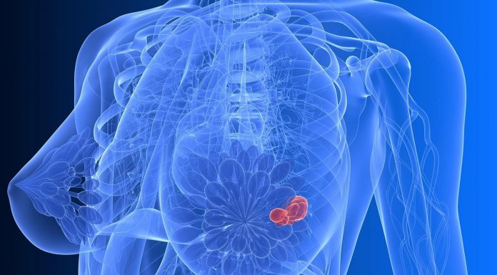 Можно ли излечиться от рака молочной железы?