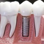 Когда можно ставить протез после удаления зуба?