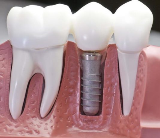 Когда можно ставить протез после удаления зуба?