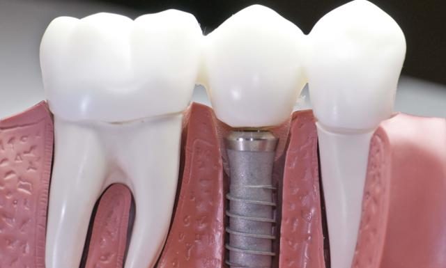 Когда можно ставить протез после удаления зуба?