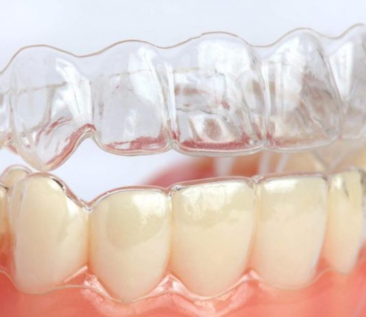 С чем связана высокая популярность элайнеров?