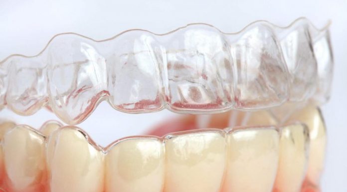 С чем связана высокая популярность элайнеров?