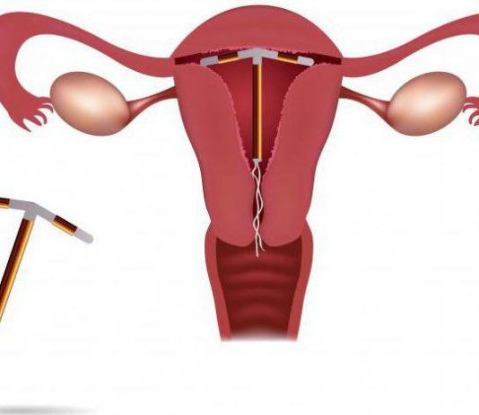 Что лечит Гормональная спираль Мирена?