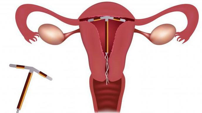 Что лечит Гормональная спираль Мирена?