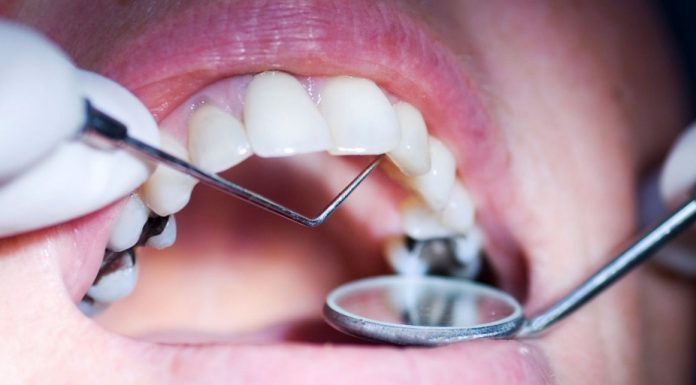 Современные методы лечения кариеса