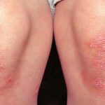 Какой метод лечения является наиболее эффективным при псориазе?