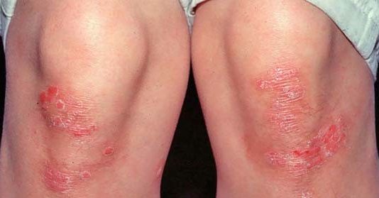 Какой метод лечения является наиболее эффективным при псориазе?