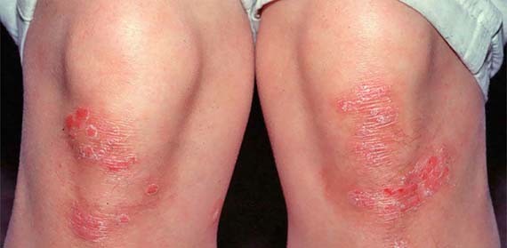 Какой метод лечения является наиболее эффективным при псориазе?