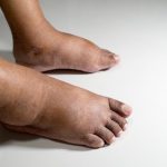 Новый метод диагностики поможет предотвратить ампутацию ног у диабетиков