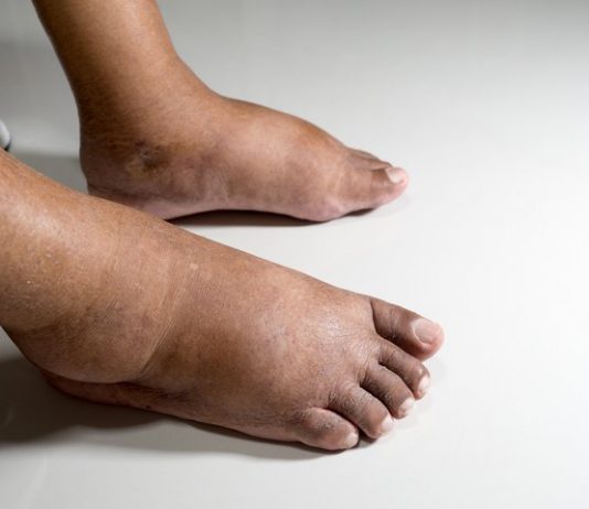 Новый метод диагностики поможет предотвратить ампутацию ног у диабетиков