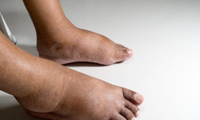 Новый метод диагностики поможет предотвратить ампутацию ног у диабетиков