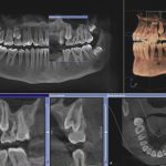Что такое 3D томография в стоматологии?
