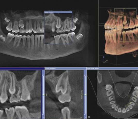Что такое 3D томография в стоматологии?