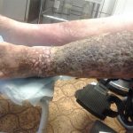 Посттромбофлебитический синдром