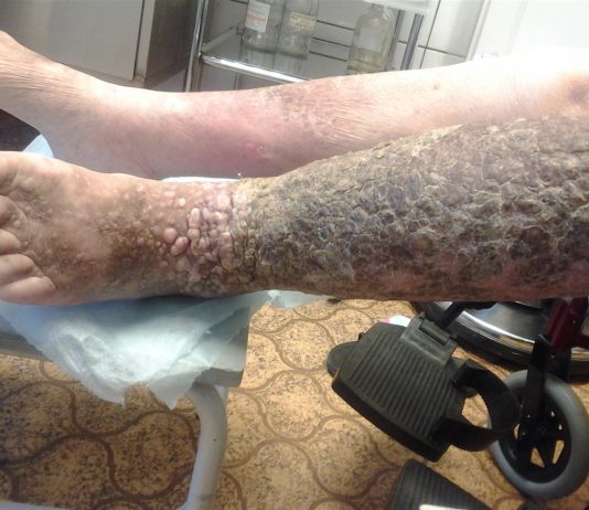 Посттромбофлебитический синдром