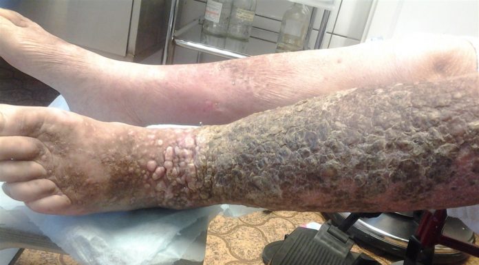 Посттромбофлебитический синдром