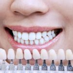 Как правильно подбирать цвет зубов при протезировании