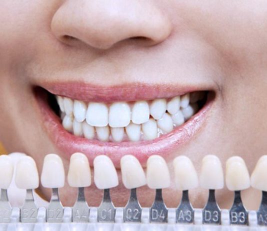 Как правильно подбирать цвет зубов при протезировании