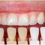 Чем отличаются композитные виниры от обычных?