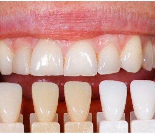 Чем отличаются композитные виниры от обычных?