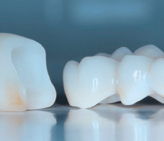 Циркониевые коронки: преимущества и недостатки