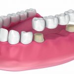 Коронки на жевательные зубы: какие лучше ставить?