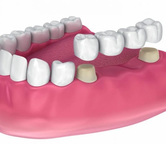Коронки на жевательные зубы: какие лучше ставить?