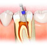 Методы лечения пульпита