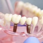 Что входит в протезирование зубов