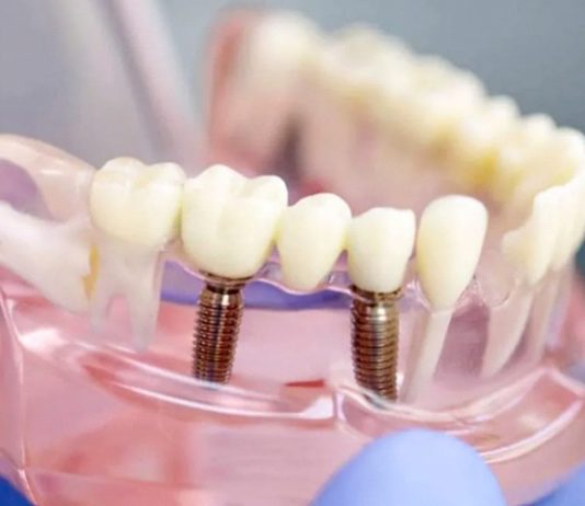 Что входит в протезирование зубов