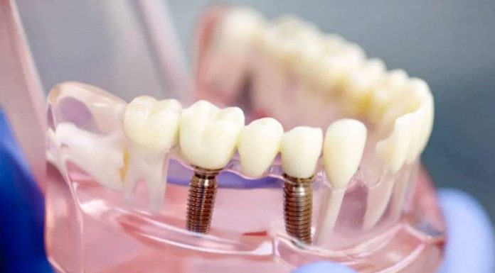 Что входит в протезирование зубов