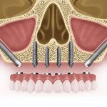 Особенности скуловой имплантации Zygoma