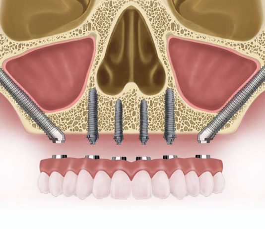Особенности скуловой имплантации Zygoma