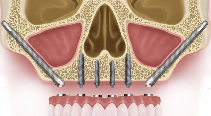 Особенности скуловой имплантации Zygoma