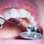 Какие есть способы лечения зубов?