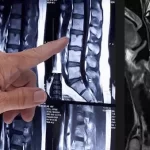 Что показывает МРТ позвоночника