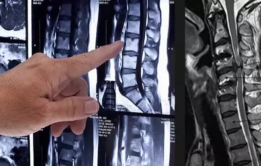 Что показывает МРТ позвоночника