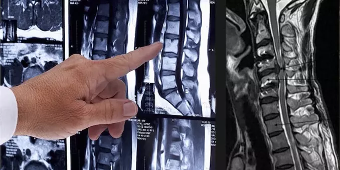 Что показывает МРТ позвоночника