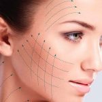 Как работает SMAS-лифтинг и зачем он нужен