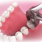 Что такое сложное удаление зуба?