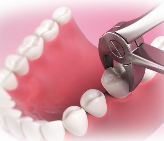 Что такое сложное удаление зуба?