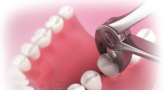 Что такое сложное удаление зуба?