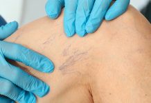 Как происходит удаление сосудистых звездочек